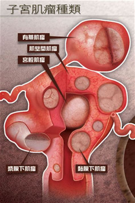 子宮 肌 瘤 血塊